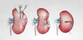 Kidney Cancer Treatments In Bangalore | World of U, Bengaluru
