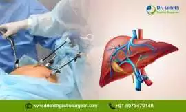 Best Laparoscopic Liver Surgeon in Sarjapur Road, Bengaluru