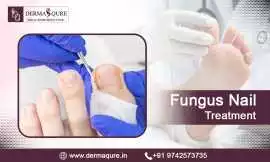 Effective Fungus Nail Treatment in Bangalore, Bengaluru