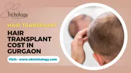 Hair Transplant | Hair Transplant Cost In Gurgaon, Faridabad