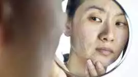 Effective Ice Pick Scars Treatment in Singapore, Bukit Timah