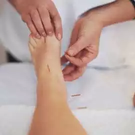Acupuncture Treatment For Foot Pain, San Francisco