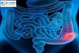 Expert Colon Cancer Treatment in Sarjapur Road, Bengaluru