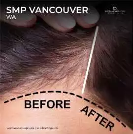 Scalp Tattoo near Vancouver: Natural-Looking SMP, Vancouver