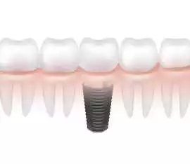 Affordable Dental Implants in Delhi at Kamal Denta, Delhi