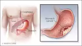Cost Of Stomach Cancer Treatment in India | HOSPID, Noida