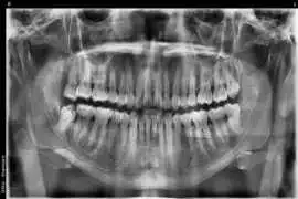 Wisdom teeth removal Tijuana, Tijuana