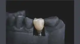 Personalized Tooth Replacement Solutions, Todos Santos