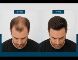 Expert Non-Surgical Hair Loss Solution in London, London