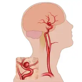 Aneurysm Coiling Procedure for Brain Aneurysm Care, Chandigarh