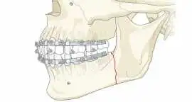 Jaw Surgery in India for Better Function & Facial , Indore