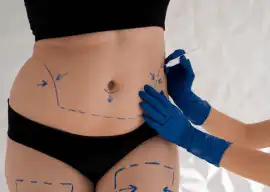Non-surgical Liposuction in Dubai - Dr. Mohan Plas, Dubai
