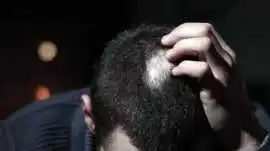 Alopecia Areata Treatment in Matunga, Mumbai
