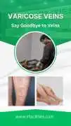 Cost of Varicose Veins Treatment | Affordably Cost, Chandigarh