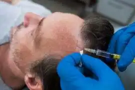 FUE vs. FUT: Comparing Hair Transplant Techniques, Allahabad