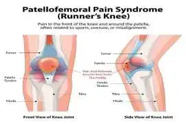 Chondromalacia Patella & Anterior Knee Pain, New York