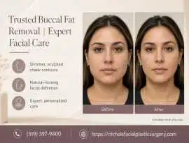 Trusted Buccal Fat Removal in London, Ontario | Ex, London