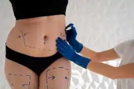 Liposuction Surgery in India At SB Aesthetics, Gurgaon