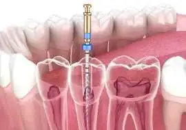 Teeth Clip Price in Coimbatore – A Complete Guide , Coimbatore