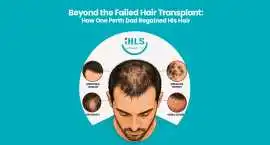 Regain Confidence with Expert Hair Restoration, Subiaco