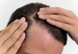 PRP Treatment in Greater Noida | DermaLinks Clinic, Noida