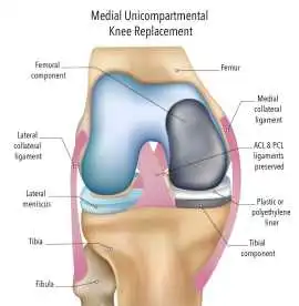 Partial Knee Replacement Surgery for Damaged Knee , Sandringham