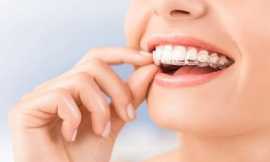 Unveiling Your Best Smile Invisalign Clear Aligner, Bukit Timah