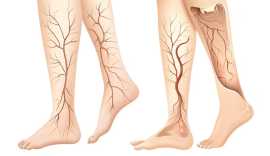 Trusted Varicose Veins Treatment in Jaipur, Jaipur