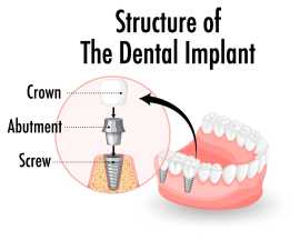 Get Dental implant clinic | Dr. Manish shah, Ahmedabad