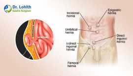 Get the Best Hernia Surgery in Bangalore, Bengaluru