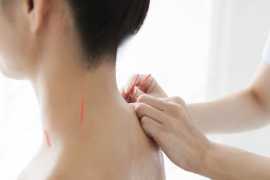 Acupuncture for Neck Stiffness in San Francisco, San Francisco