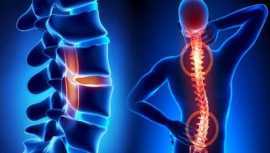 How Does Homeopathy Help in Spine Problems?, Patna