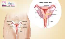 Best Endometrial Cancer Treatment in Manipal, Bengaluru