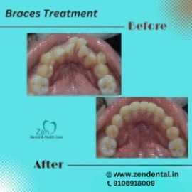 Best Dental Braces Treatment in Bangalore, Bengaluru