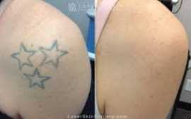 Effective Laser Tattoo Removal in Singapore, Novena