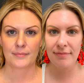 Revitalize Your Skin with Plasma Injections, Warrenton