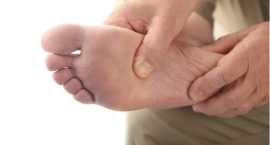 Stem Cell Treatment for Diabetic Foot Ulcers, Delhi