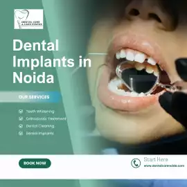 Benefits of Getting Dental Implants in Noida at De, Noida