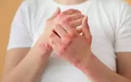 Atopic Dermatitis Needs More Than Just Moisturizer, Tiruvalla