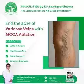 Find the Best Hospital for Varicose Vein Treatment, Chandigarh