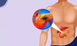 Affordable Pancreatic Cancer Treatment Cost in Ind, Noida