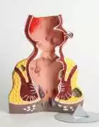 Fistula in Ano Treatment Without Surgery, Lucknow