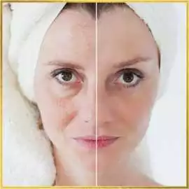 Facelift Treatment in Los Angeles, Los Angeles