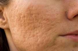 Smooth Your Skin: Pitted Scars Treatment in Singap, Bukit Timah
