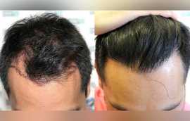 Best Hair Transplantation Cost in Jaipur, Jaipur