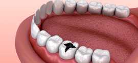 White Fillings | Denvolve, London