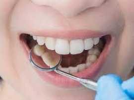 Is veneer good for teeth?, Bukit Timah