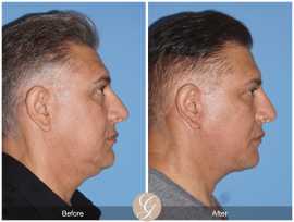 Discovering the Leading Neck Lift Surgeon in Newpo, Newport Beach