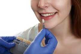 5 essential benefits of dental veneer, Bukit Timah