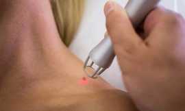 Revitalize Your Skin with Professional Mole and Sk, London